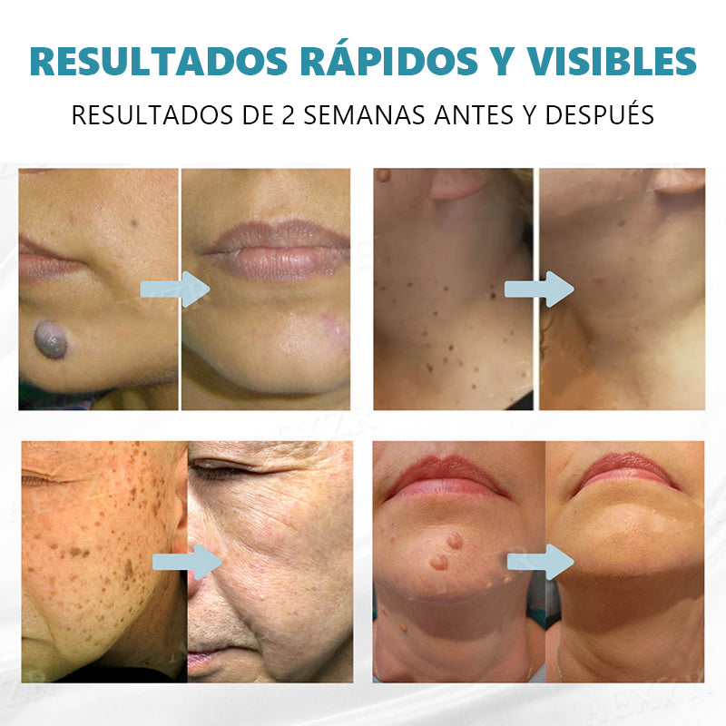 Lápiz láser no invasivo Bikenda® para la eliminación de lunares y verrugas